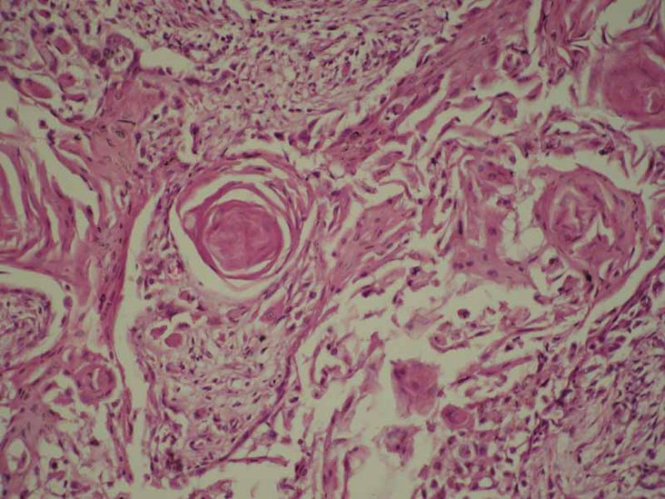 Zdjęcia ze strony katedry patomorfologii - CarcinomaPlanocellulareKeratodes_x20.jpg